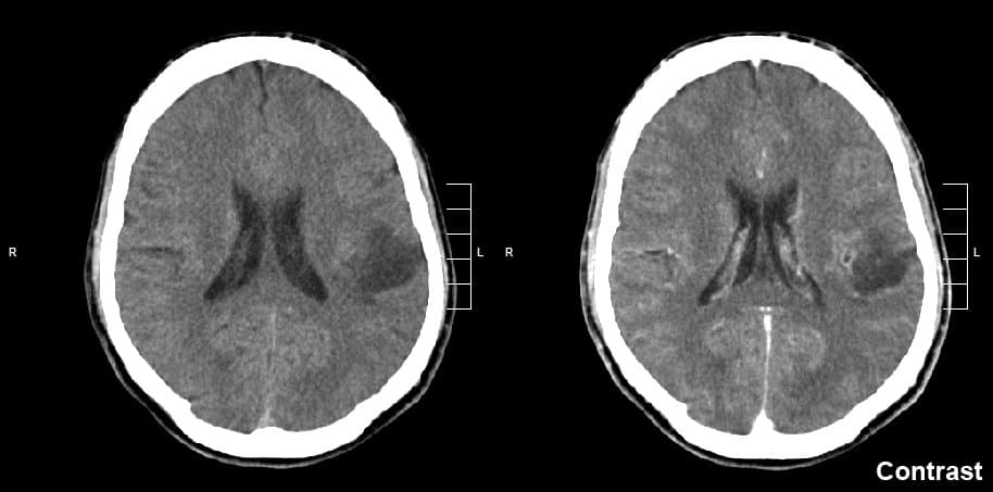 Proton therapy leads to positive survival and quality of life outcomes for patients with lower grade glioma