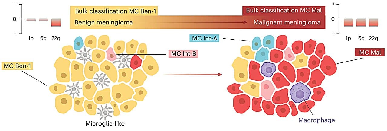 Brain Tumor Recurrence: New Prediction Method