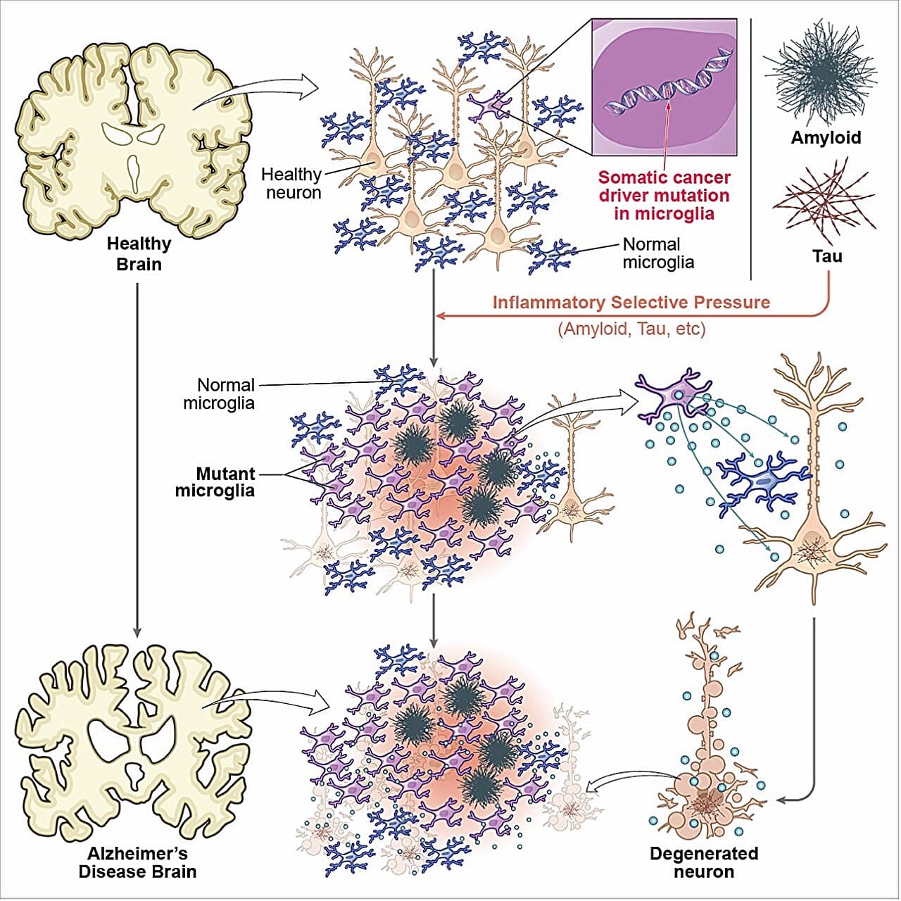 Unexpected cancer mutations in brain's immune cells may help fuel Alzheimer's disease
