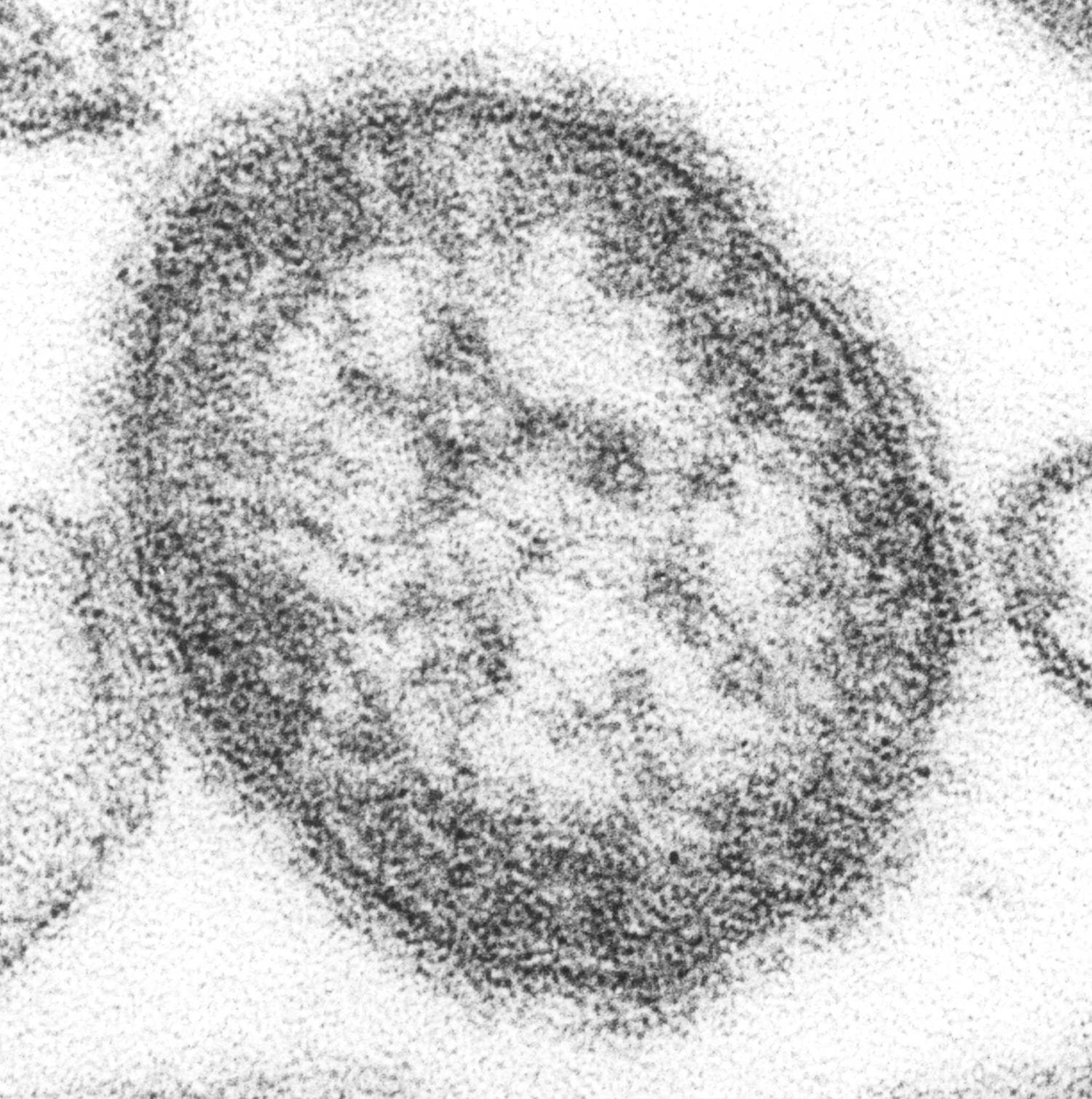 US may lose measles elimination status after outbreaks spread to 45 states