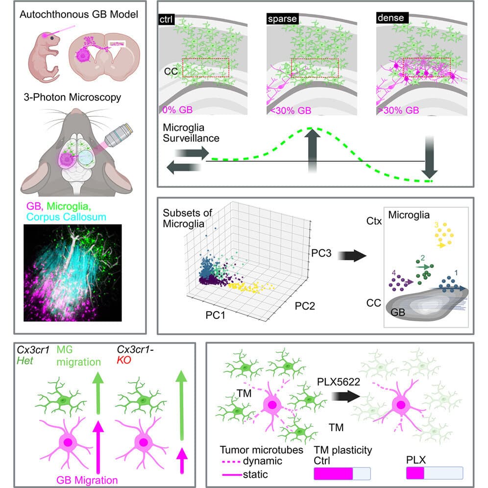 Advanced imaging uncovers immune cells' changing role during glioblastoma invasion