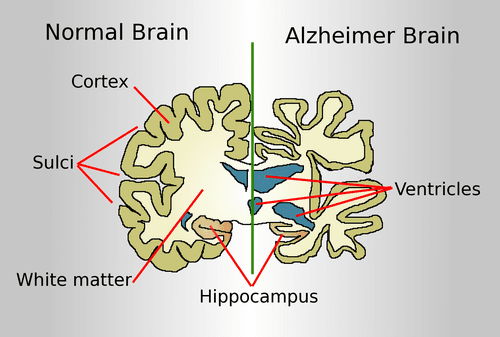 Comparison of a healthy brain versus a brain affected by Alzheimer's disease