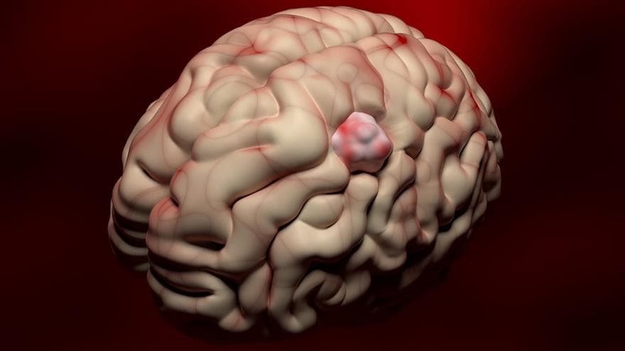 Researchers Identify Novel Vulnerability in Breast Cancer Brain Metastases (via drexel.edu)