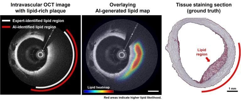 AI & Optical Imaging Detect Coronary Artery Plaques (via optica.org)