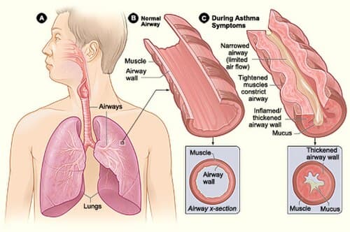 NIH medical illustration showing the airways during an asthma attack