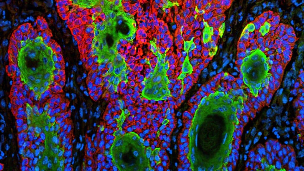 Replimune skin cancer drug that became FDA flashpoint is rejected again